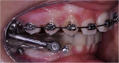 Evaluation of the Co–Go–Me angle as a predictor in Class II patients treated with Herbst appliance and skeletal anchorage: a retrospective cohort study